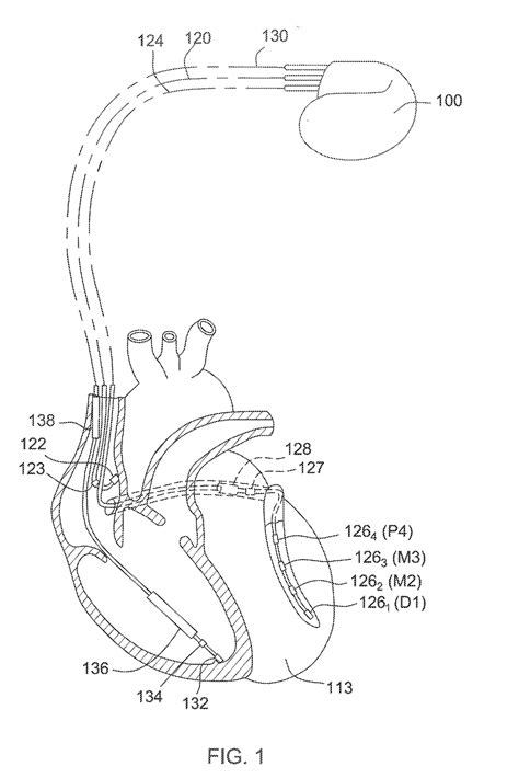 Hemodynamic Optimization of Pacing Configuration in .